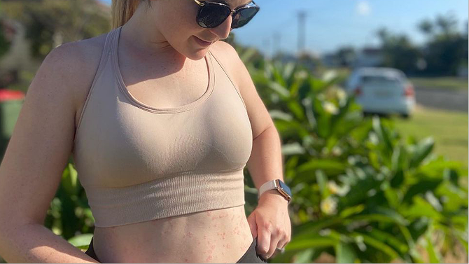 Learning to Live With Psoriasis: Overcoming Stress and Shame